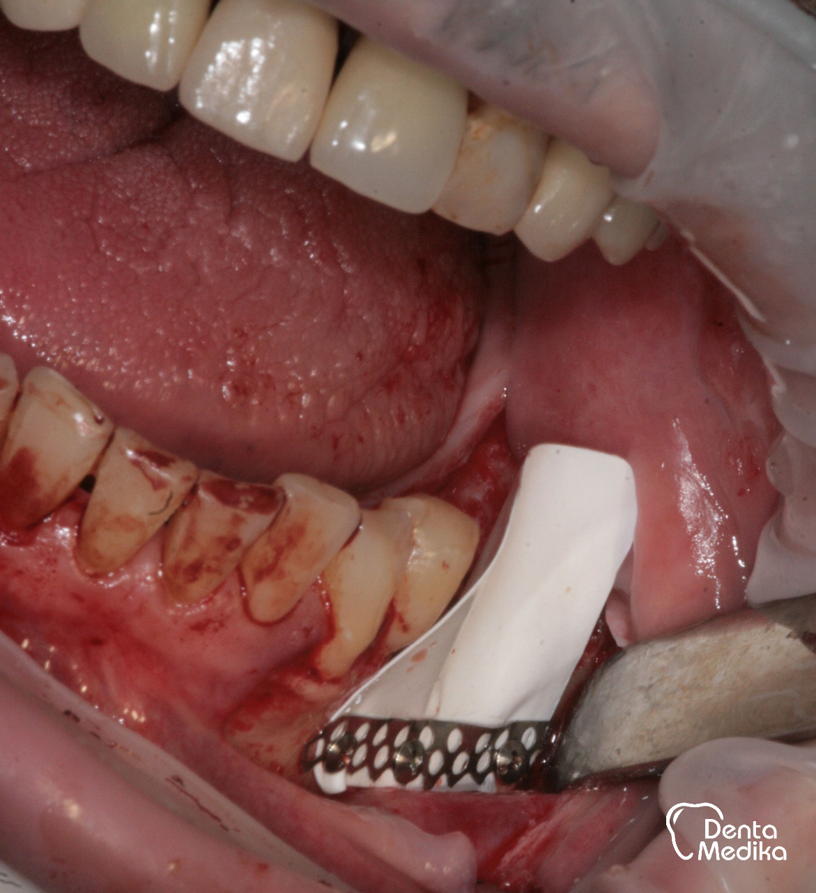 Augmentace kosti Dentamedika Brno 2